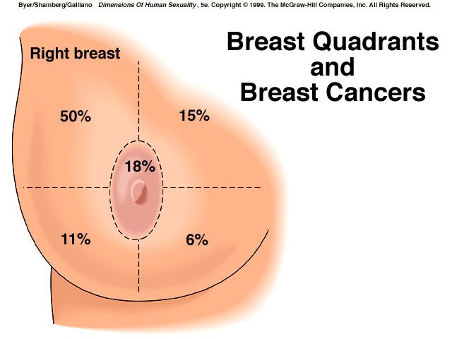 Breast Cancer Topic: Quadrants of Breast Cancer