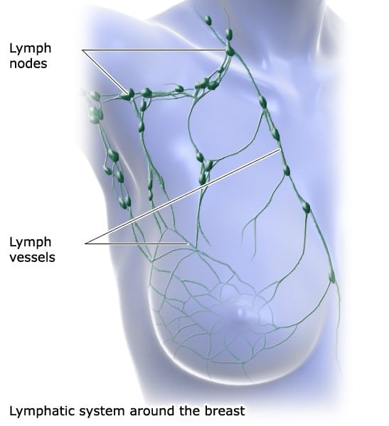 Breast cancer: Treating lymphedema