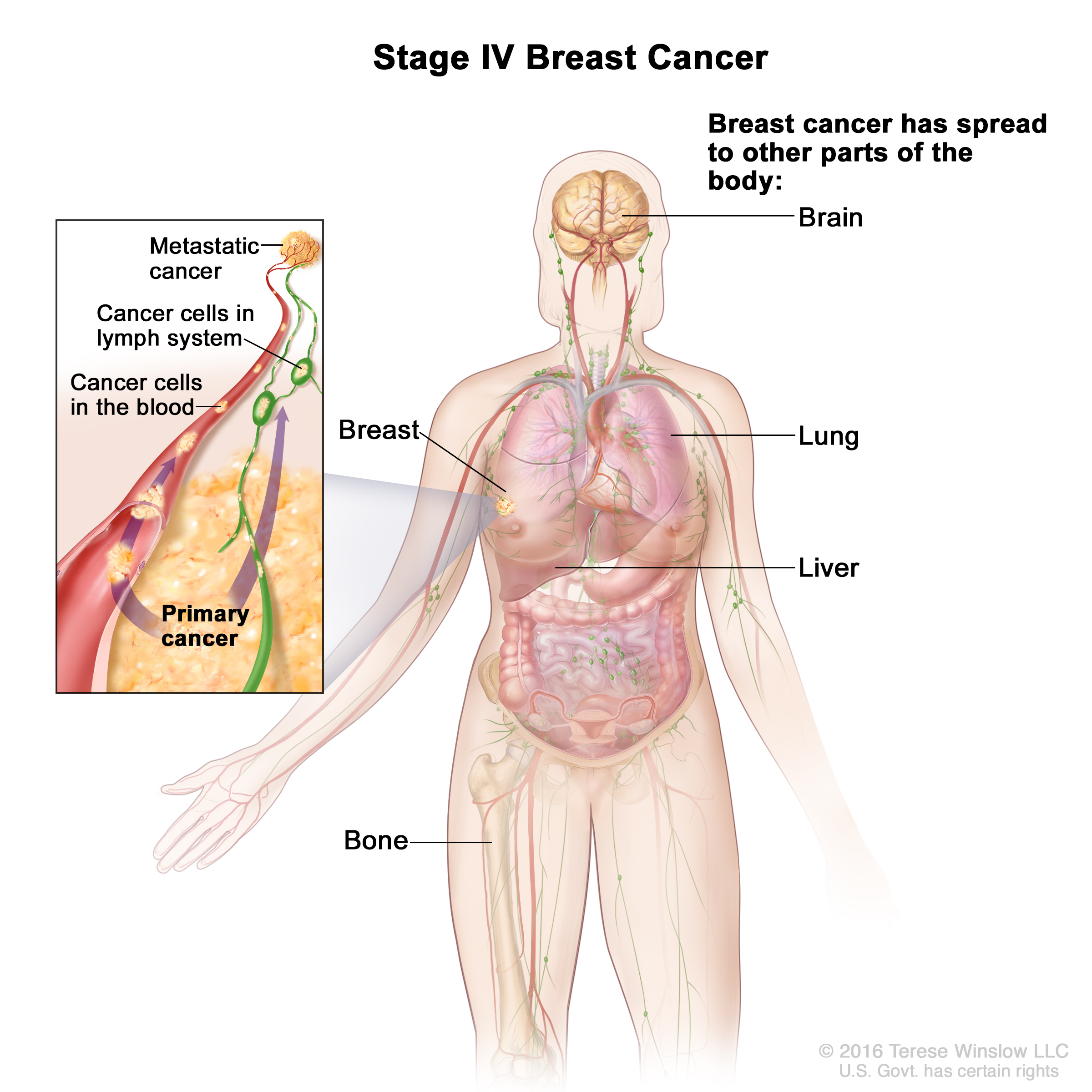 Breast Cancer Treatment (Adult) (PDQ®) (Patients)