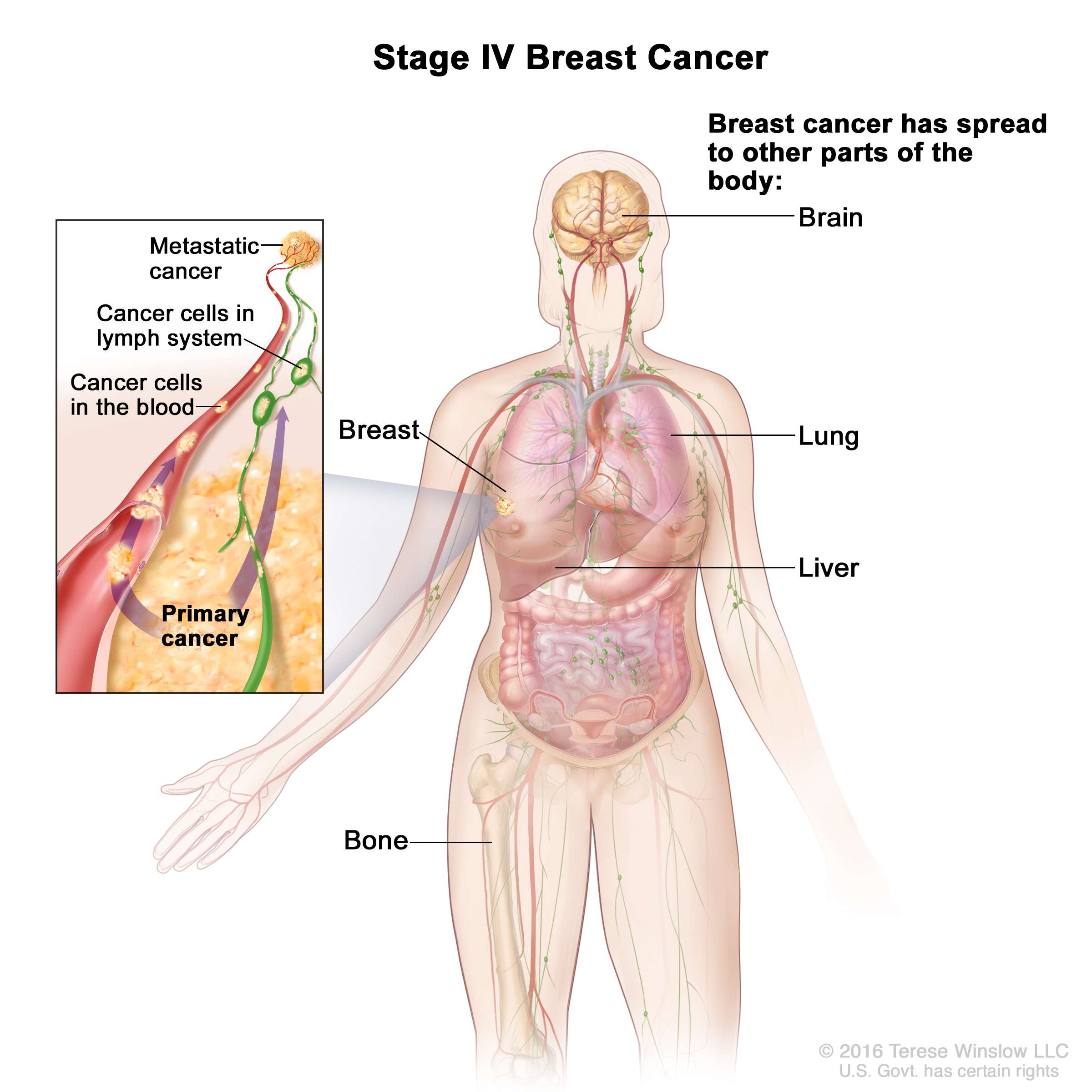 Breast Cancer Treatment (Adult) (PDQÂ®) (Patients)
