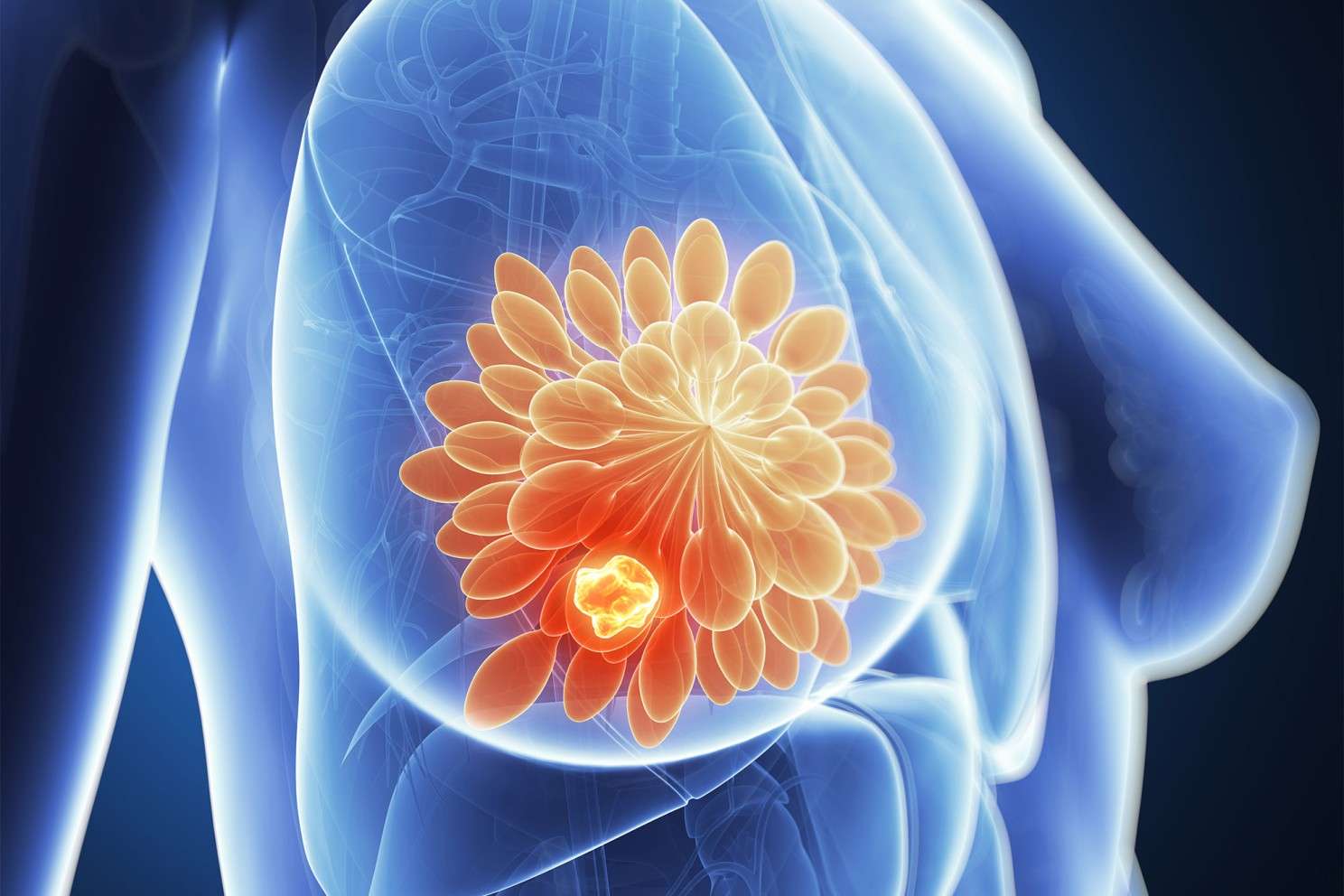 Breast cancer treatment could lead to incurable tumors years later