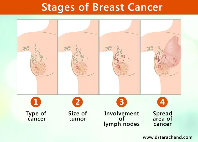 Breast Cancer Treatment in Jaipur by Dr. Tara Chand ...