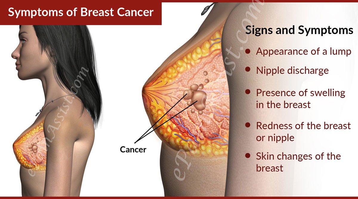 Breast Cancer: Treatment, Prevention, Symptoms, Stages, Signs