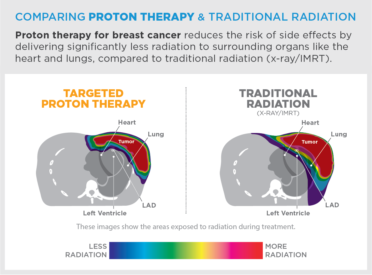 Breast Cancer Treatment  Provision CARES Proton Therapy ...