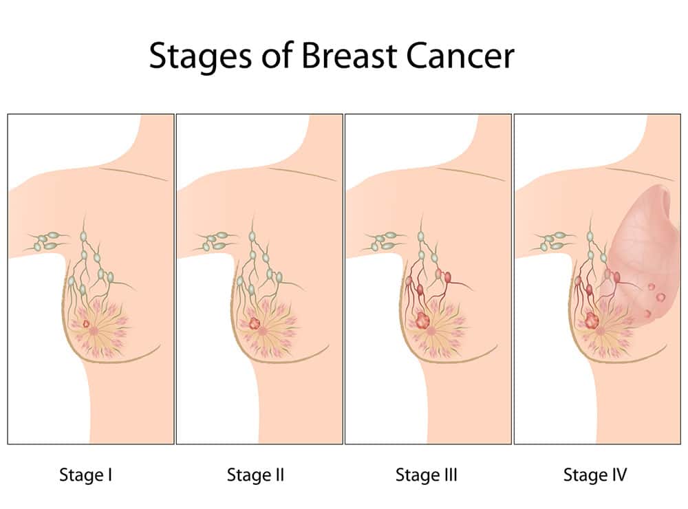 Breast Cancer: Typing and Staging â? Cancer Compass~An ...