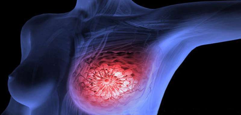 Breast cancers detected at smaller size in women with implants