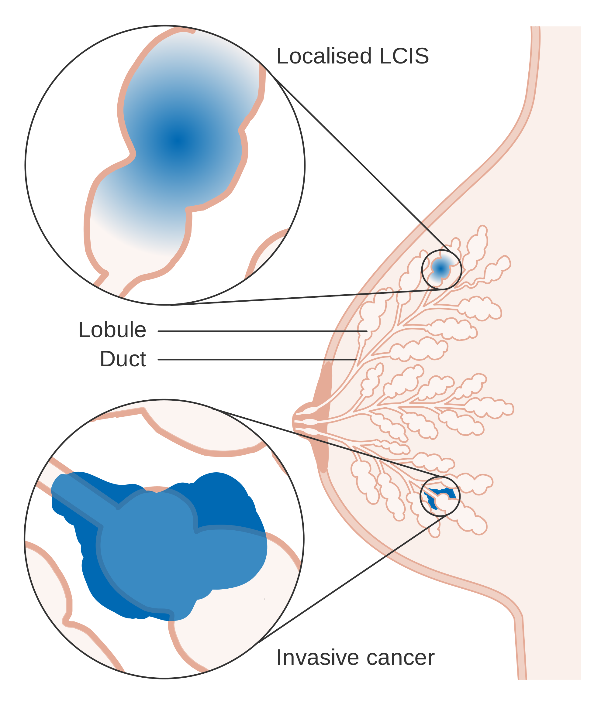 Breast Carcinoma in Situ