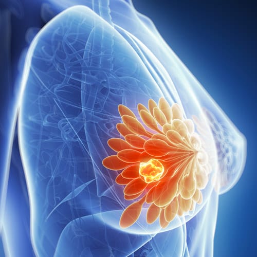 Breast cysts: causes, symptoms, diagnosis and treatment. How to treat ...