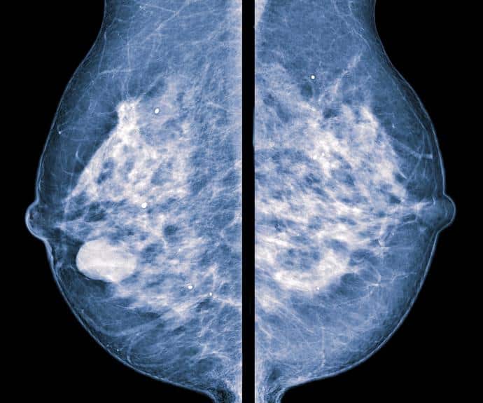 Breast density biggest risk factor of breast cancer