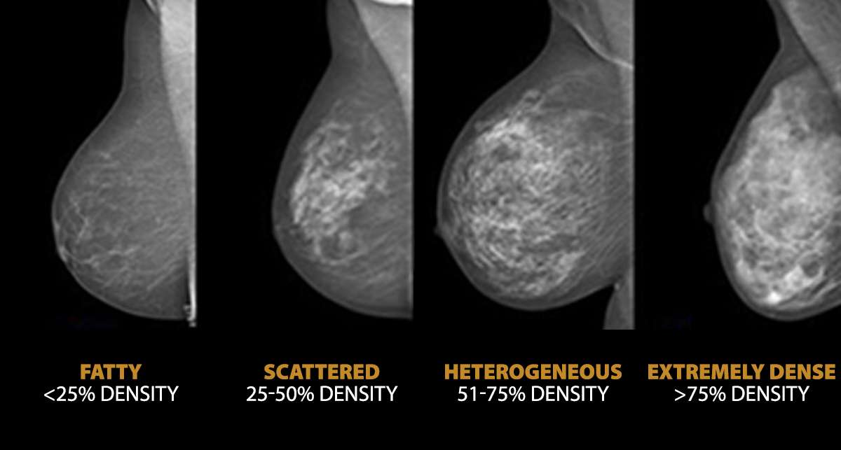 Breast Density: Does it really matter?  Life Among Women