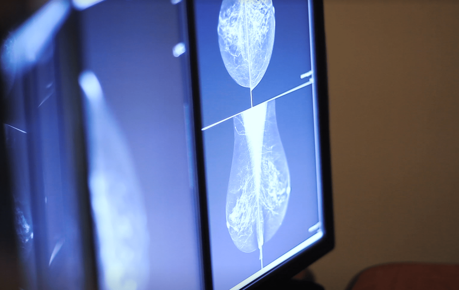 Breast Density: Video