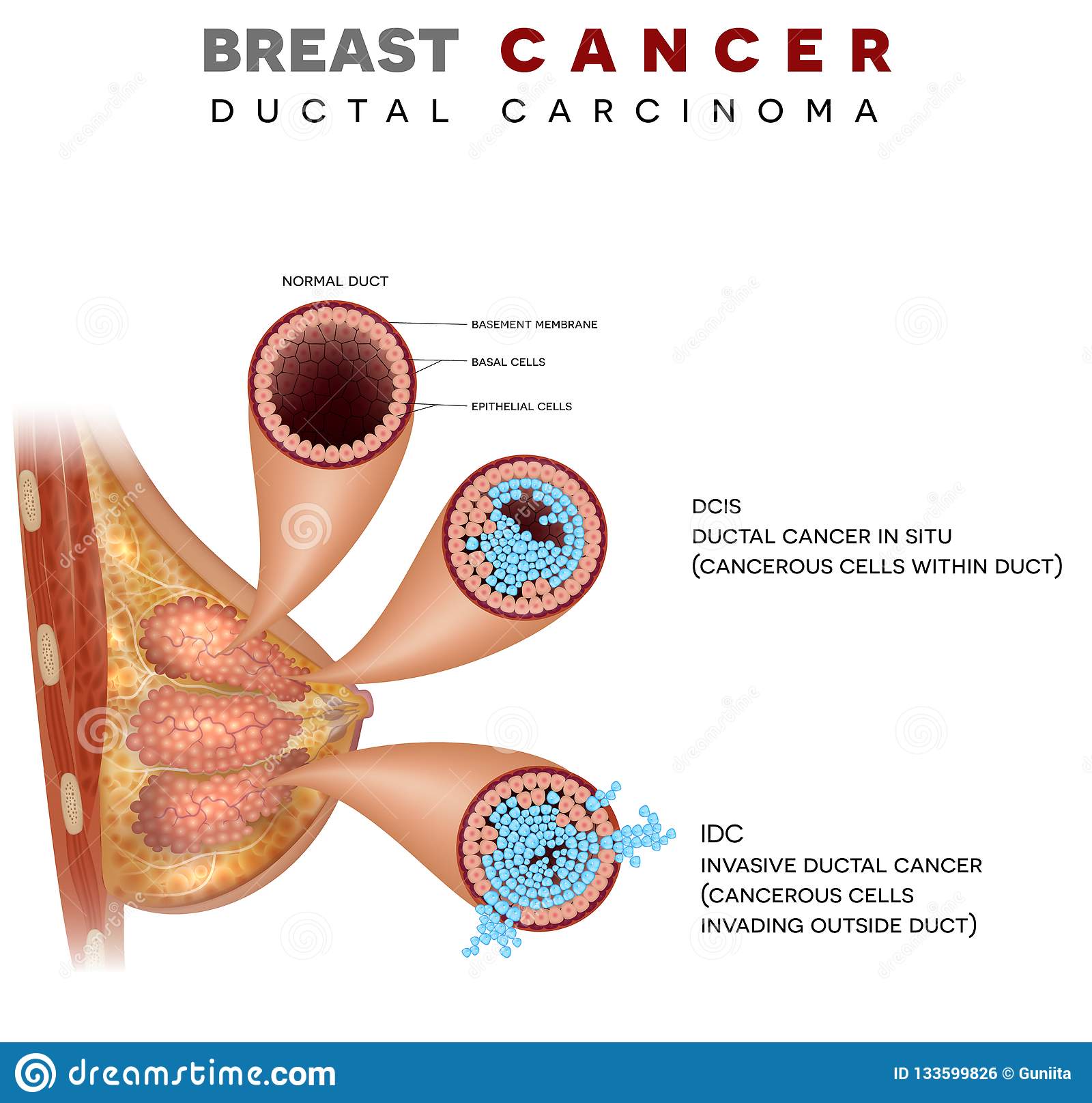 Breast Ductal cancer stock vector. Illustration of info