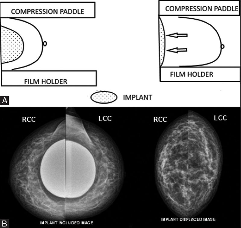 Breast Implants, Breast Cancer and Screening