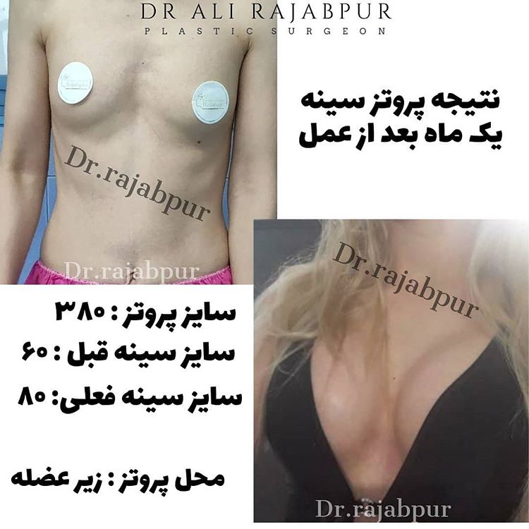 Breast Implants by Dr. Ahmad Ali Rajabpur