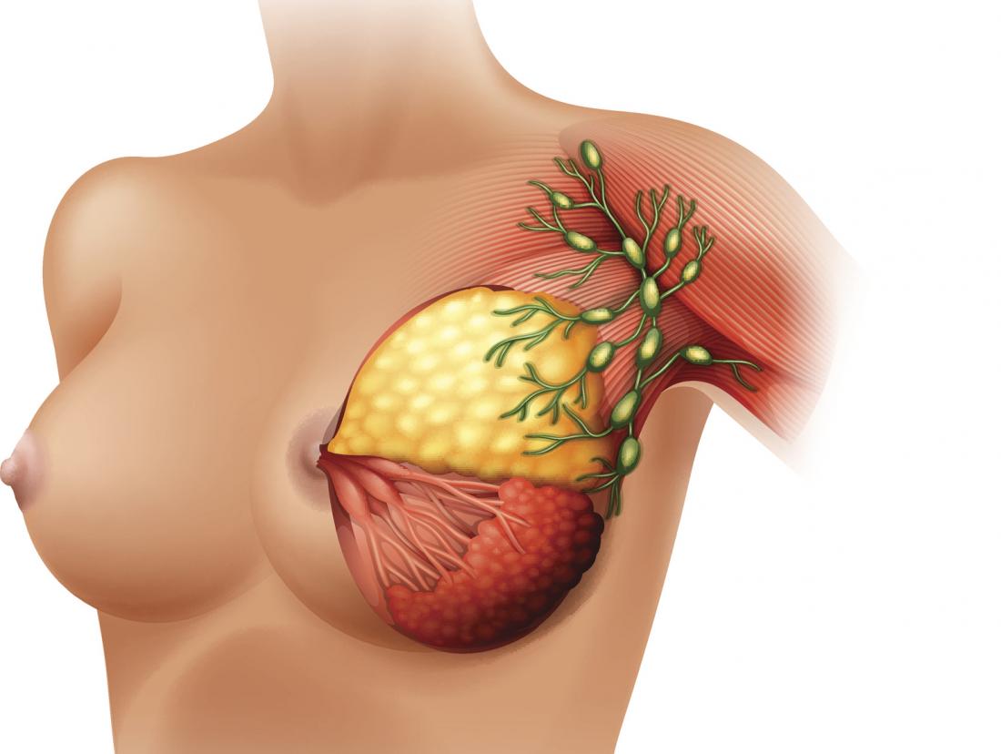 Breast lumps: Causes, types, checking, and treatment