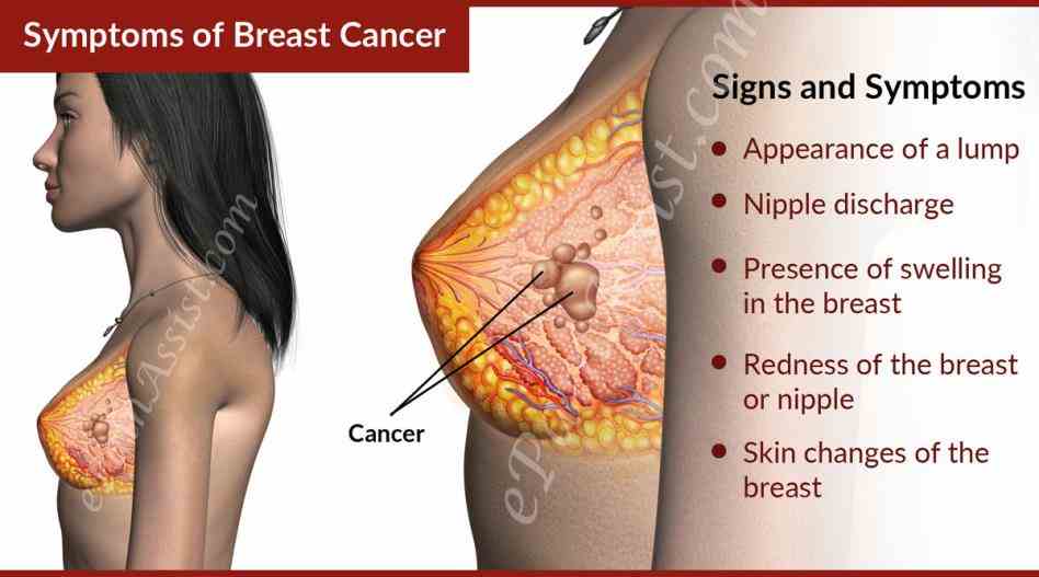 Breast Pain Cancer Symptoms