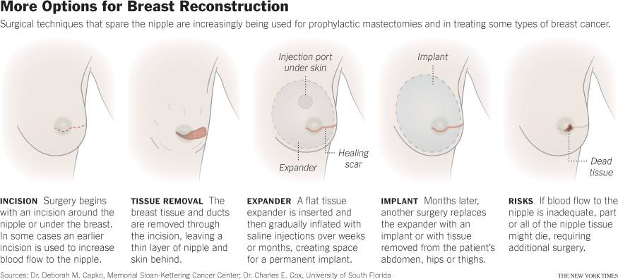 Breast Reconstruction Techniques : The Best Breast Reconstruction ...