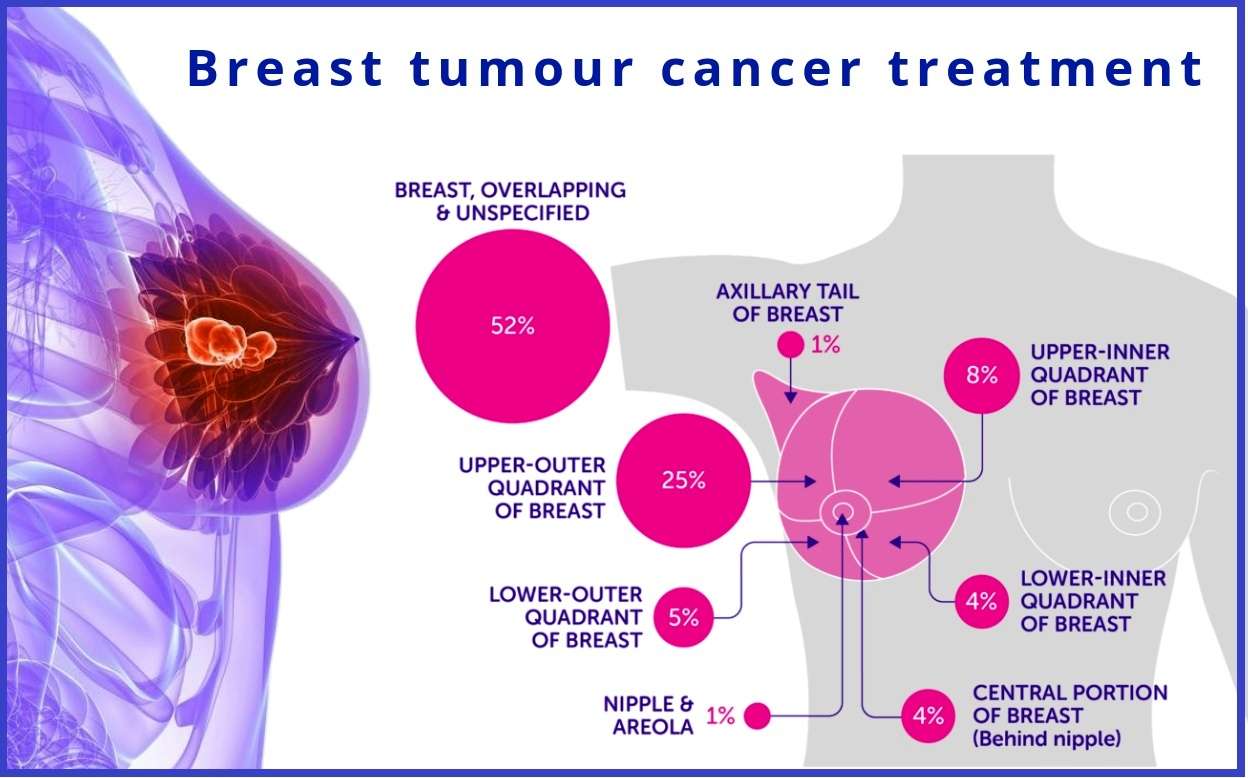 Breast tumour cancer Homeopathic treatment