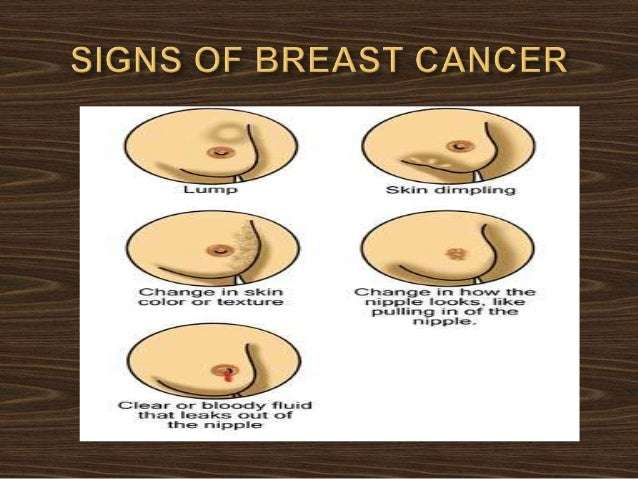 Breastcancer 140220114523