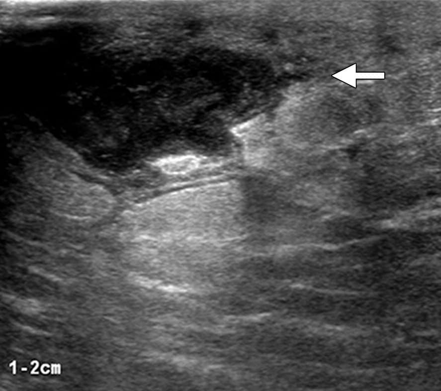 Can Breast Cancer Be Diagnosed With Ultrasound