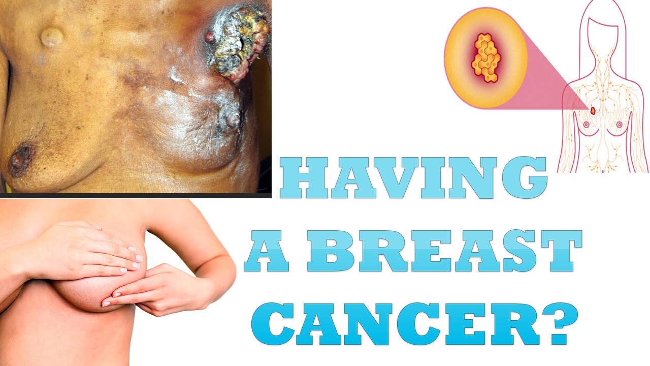 Can men have breast cancer Aanal Hd  Balvubjc