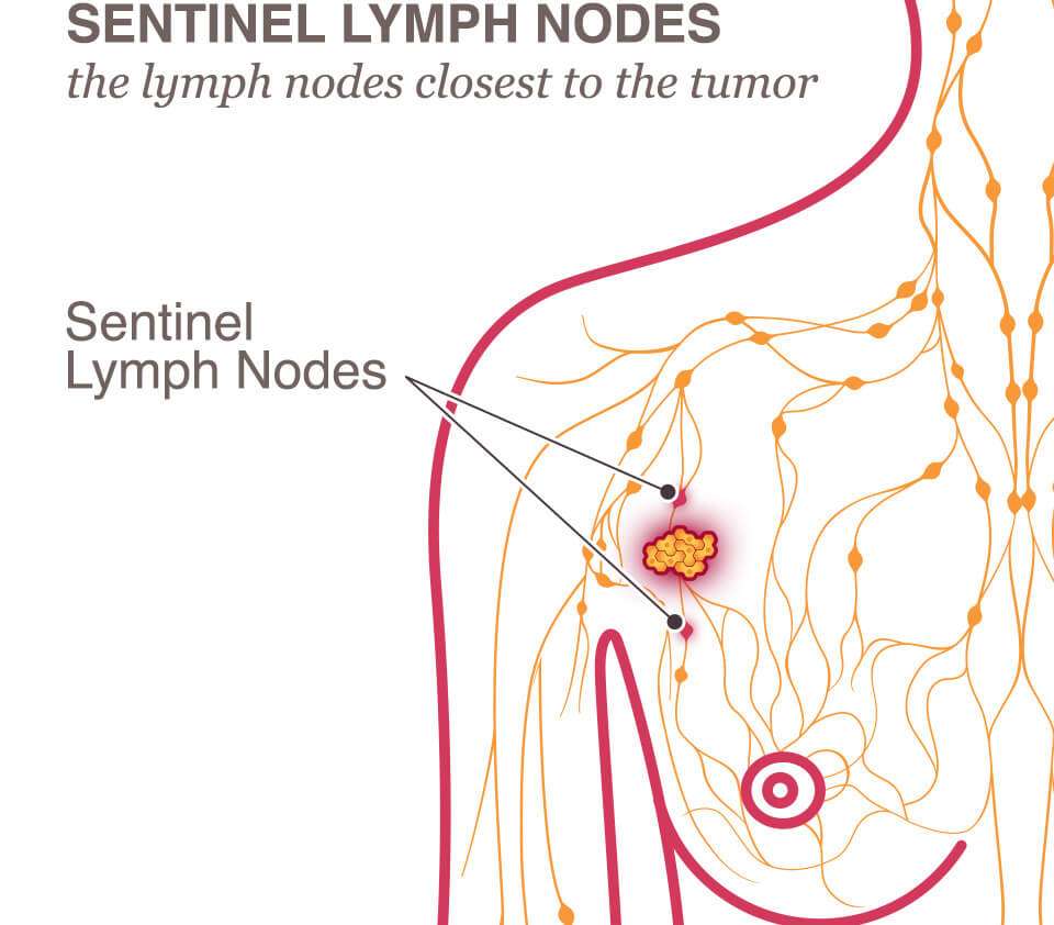 Cancer metastatic to lymph node axilla