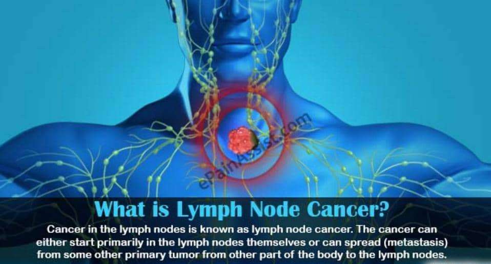 Cancer Spread to Lymph Nodes Life Expectancy