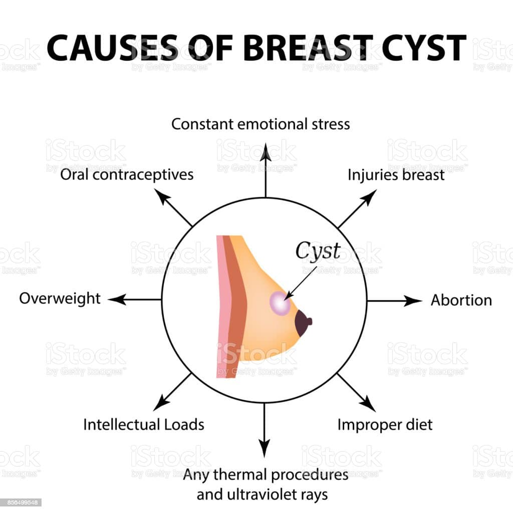 Causes Of Cyst In The Mammary Gland World Breast Cancer Day Tumor ...