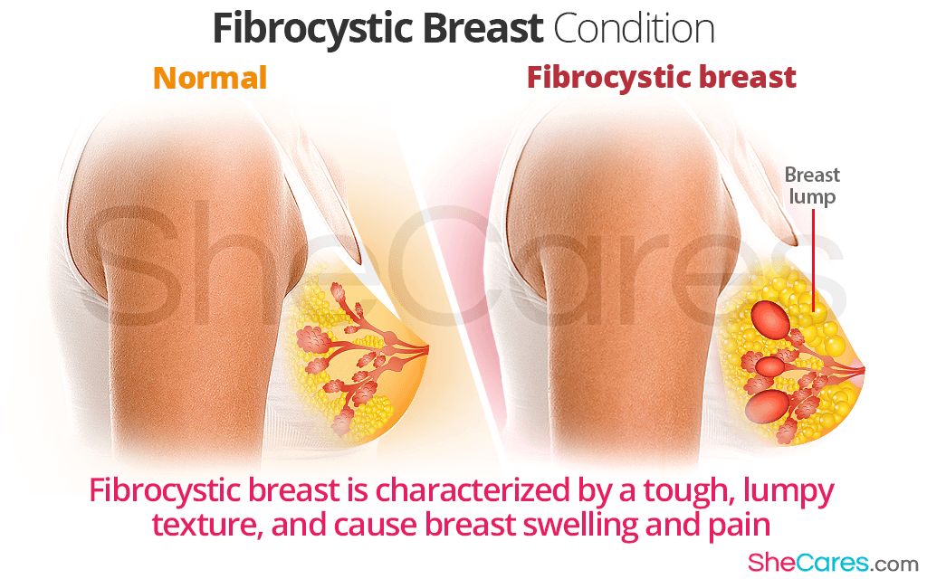 Causes of fibrocystic breast . Nude pics.