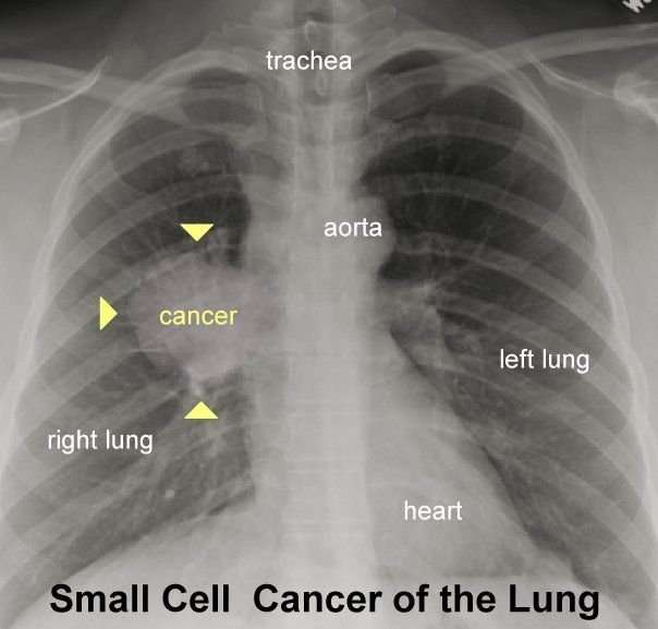 Chest X Ray Showing Lung Cancer