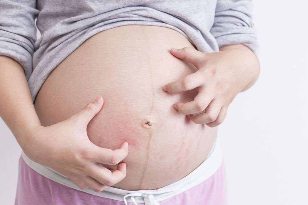Cholestasis: An Itch You Can