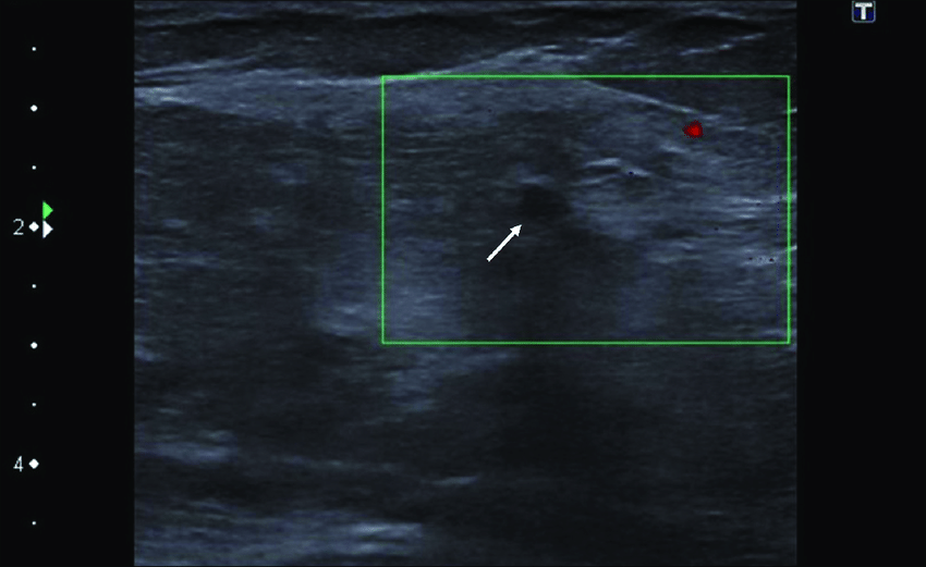Color Doppler ultrasound. Breast ultrasound of the non ...