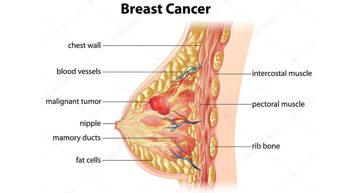 Common Forms of Cancer Afflicting Women