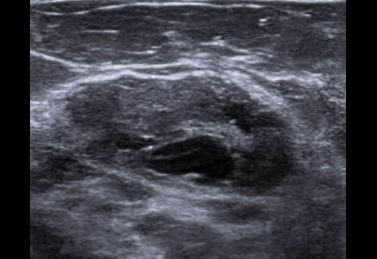 Complex Breast Masses: Is There an Echo in Here?