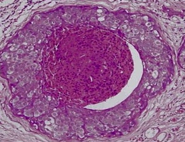 DCIS ductal carcinoma in