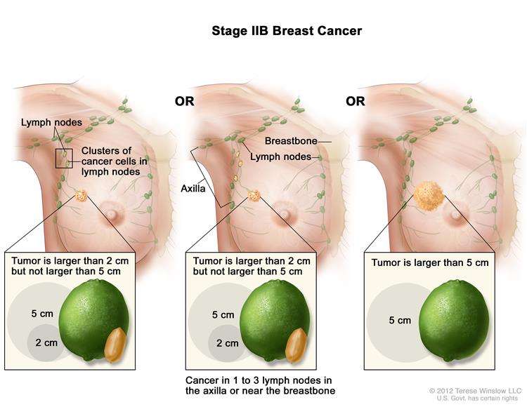 Definition of stage II breast cancer