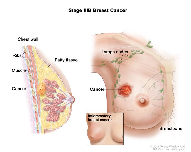 Definition of stage IIIB breast cancer