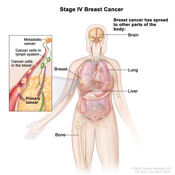 Definition of stage IV breast cancer
