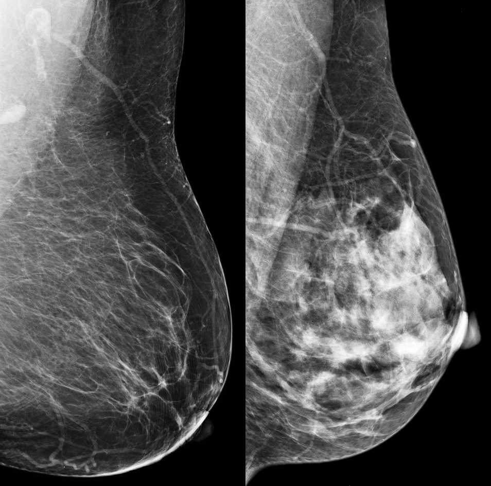 Dense Breast Tissue Signals Higher Risk For Breast Cancer ...