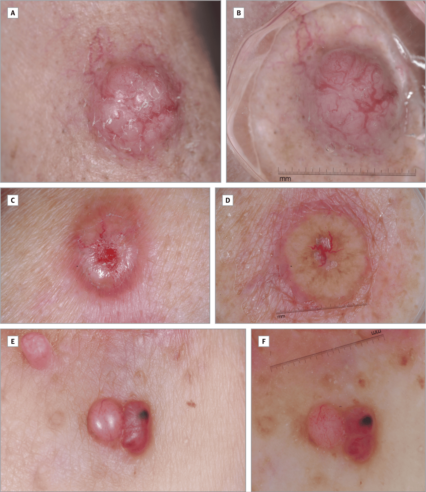 Dermoscopic Findings in Cutaneous Metastases