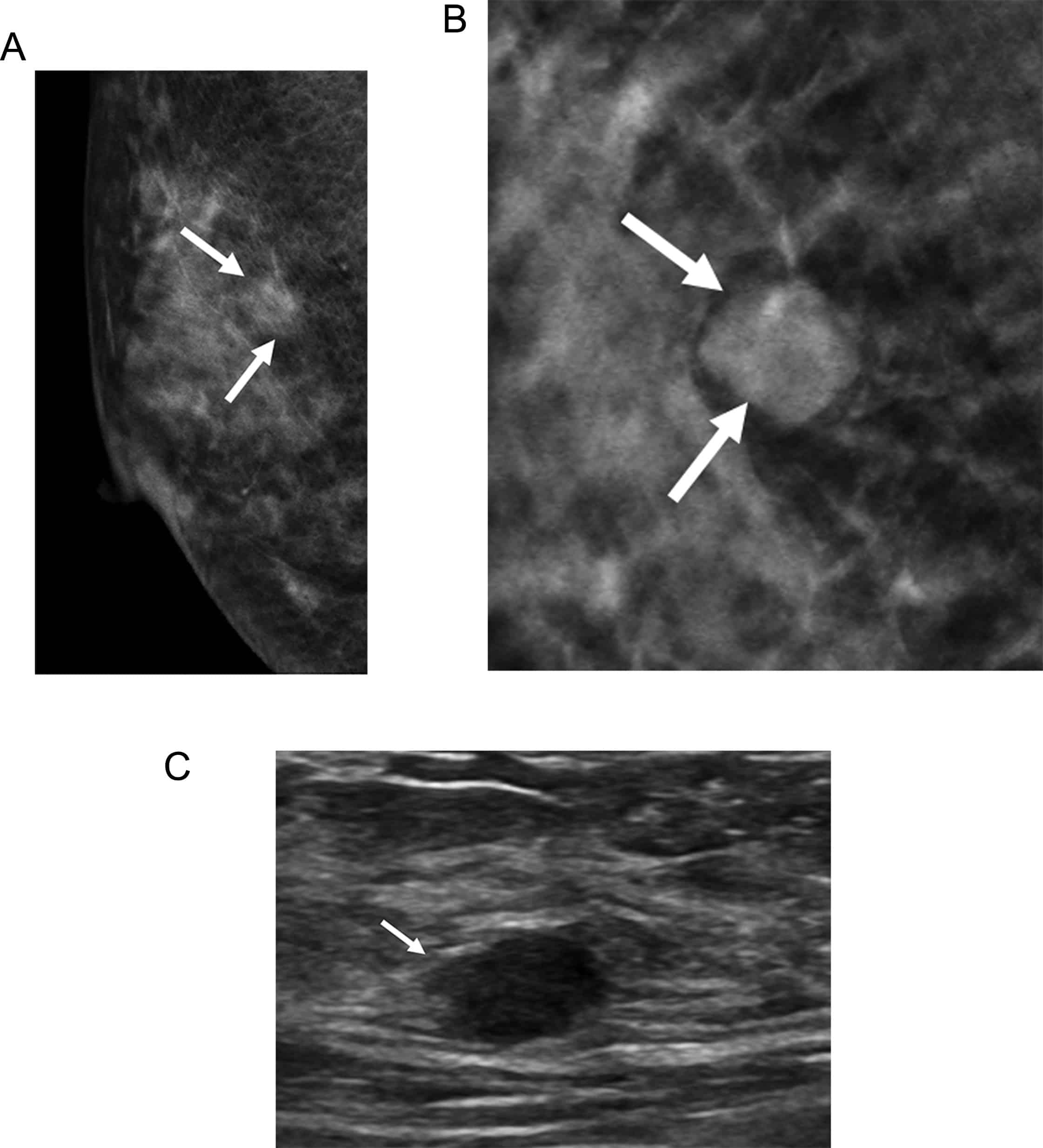 Digital breast tomosynthesis and breast ultrasound: Additional roles in ...
