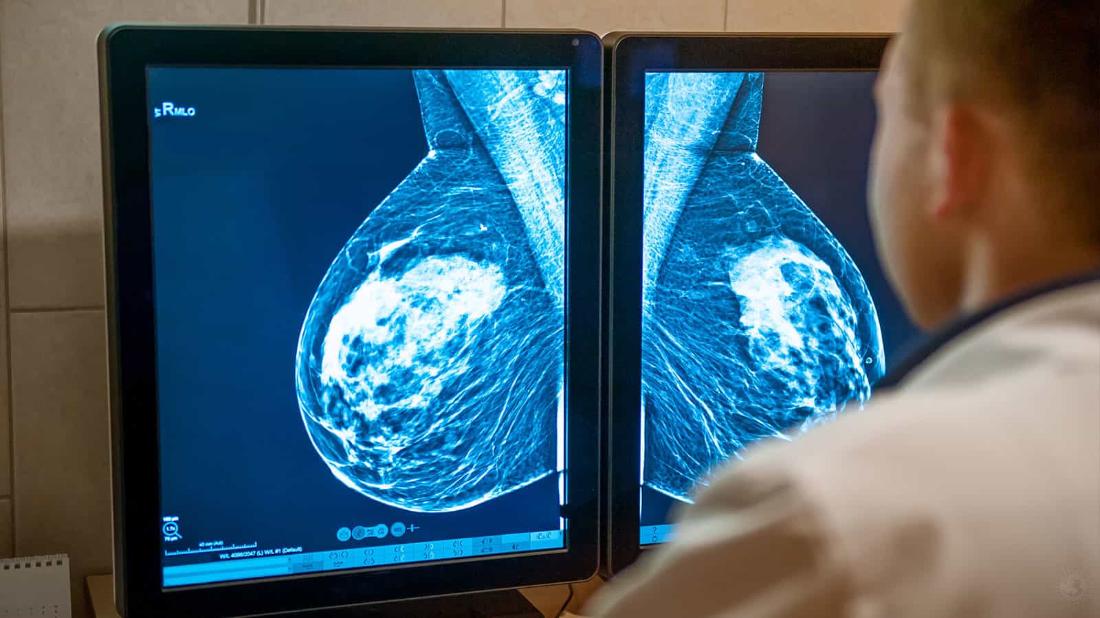 Doctors Explain A Mammogram is the Best Way to Detect Breast Cancer