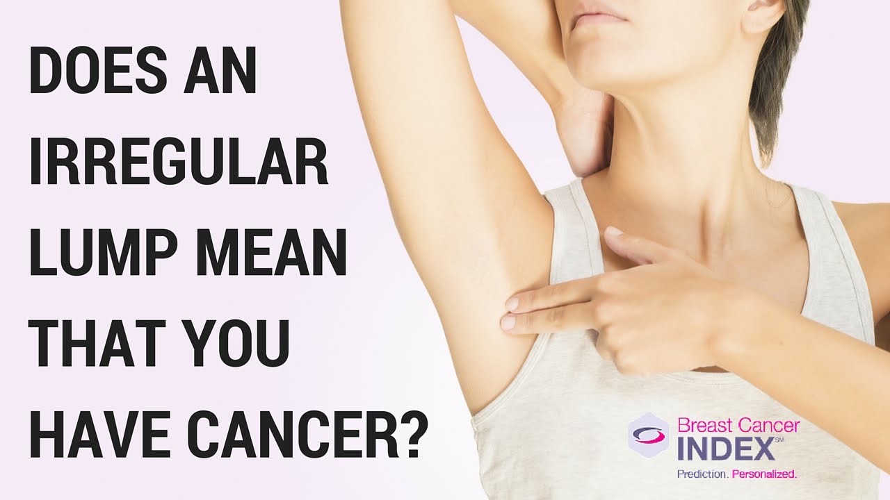 Does an Irregular Lump Mean That You Have Breast Cancer ...