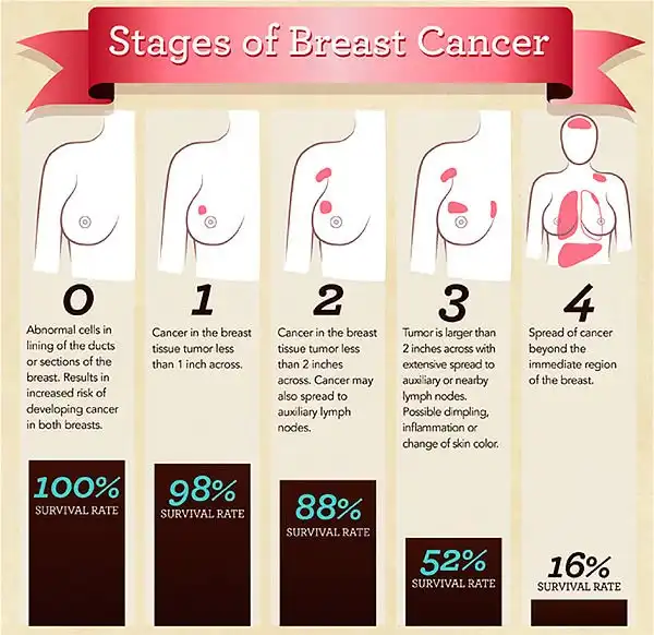 Does Stage 2 Breast Cancer Require Chemotherapy