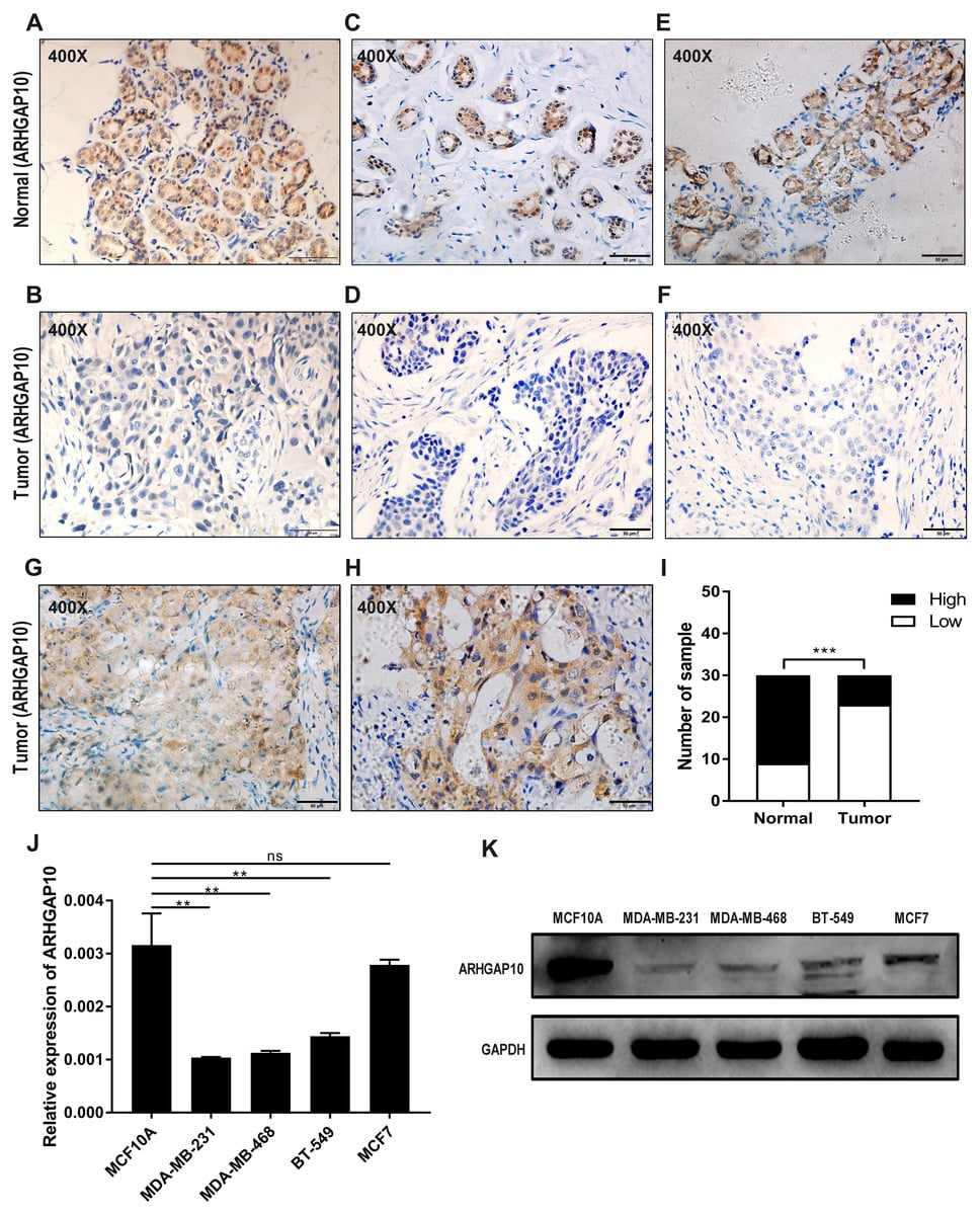 Downregulated expression of ARHGAP10 correlates with advanced stage and ...