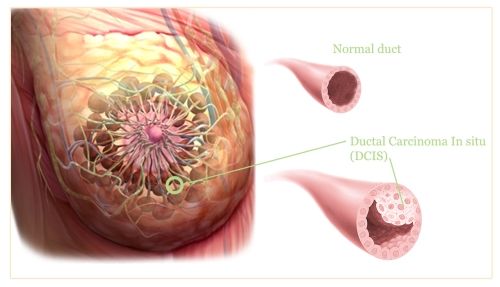 Ductal Carcinoma in Situ (DCIS) &  Mastectomy
