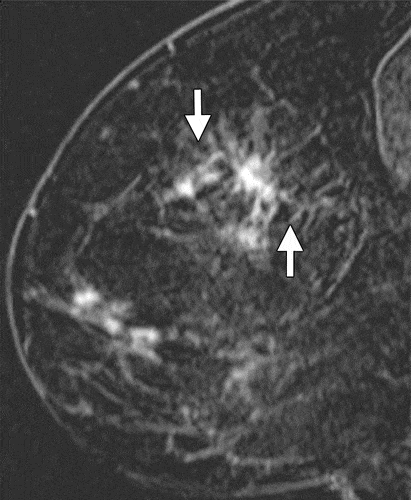 Ductal Carcinoma in Situ of the Breasts: Review of MR Imaging Features ...
