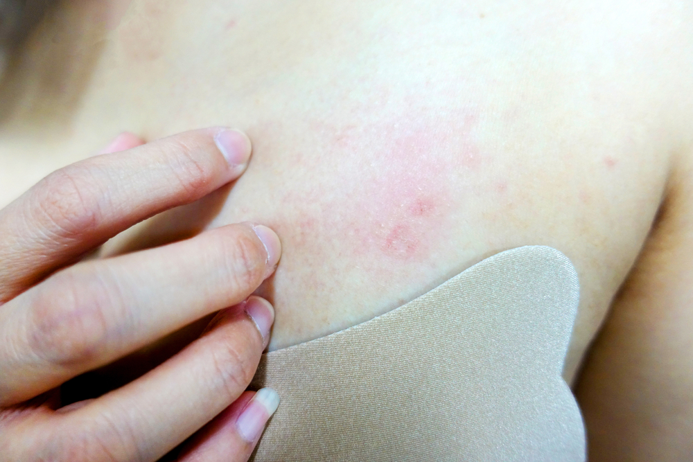 Early Inflammatory Breast Cancer Rash Pictures : Top 10 Inflammatory ...