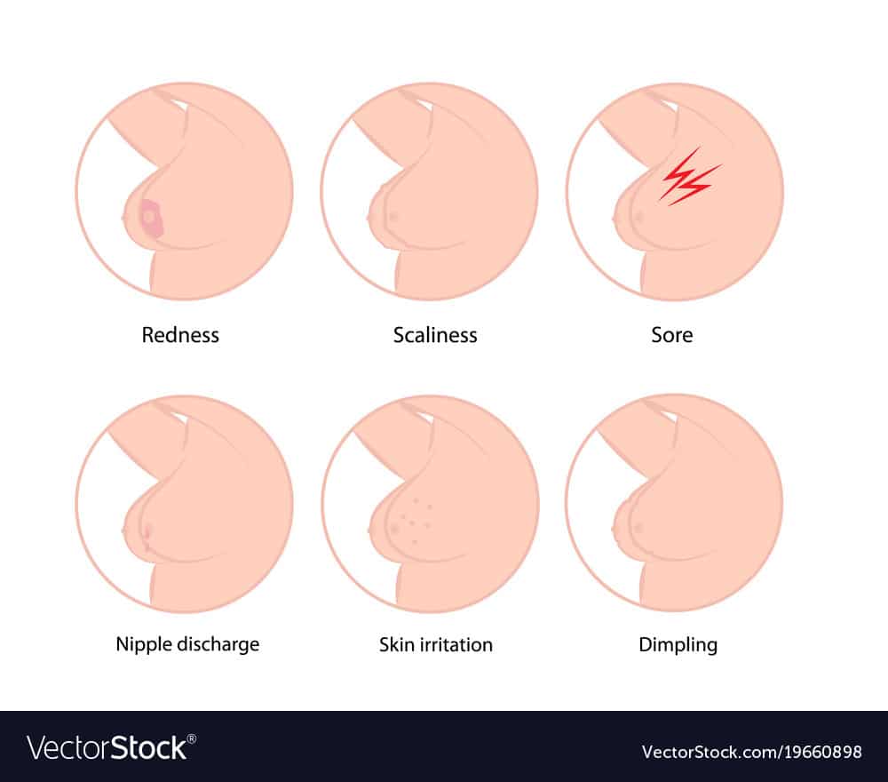 Early symptoms of breast cancer Royalty Free Vector Image
