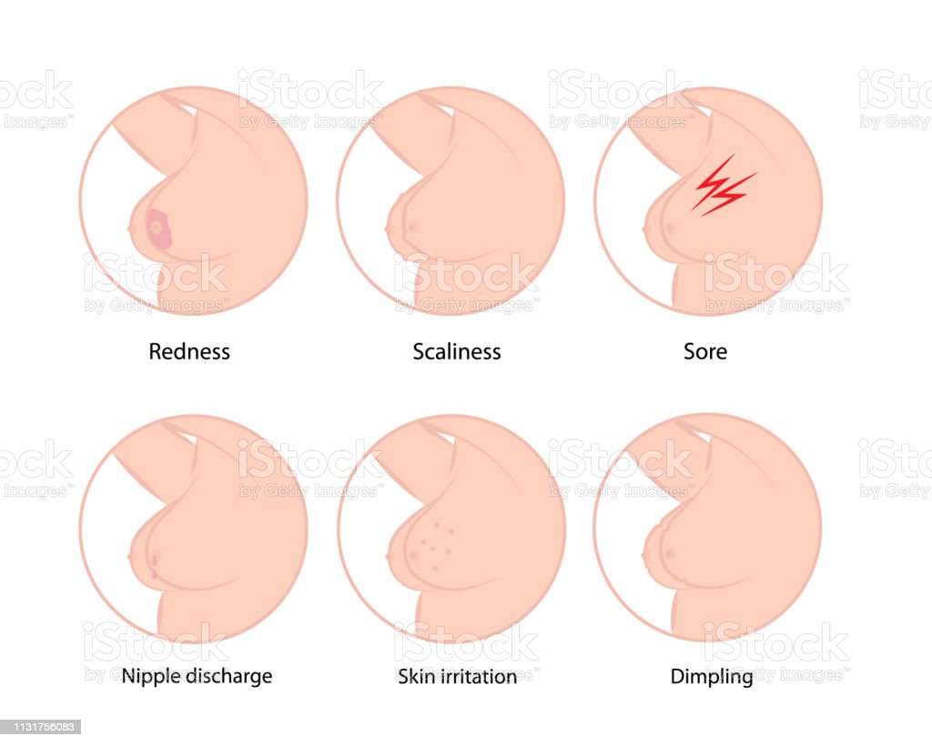 Early Symptoms Of Breast Cancer Stock Illustration